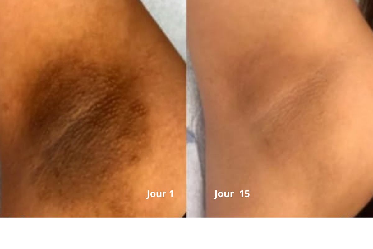 Résultat avant après NYALI 5