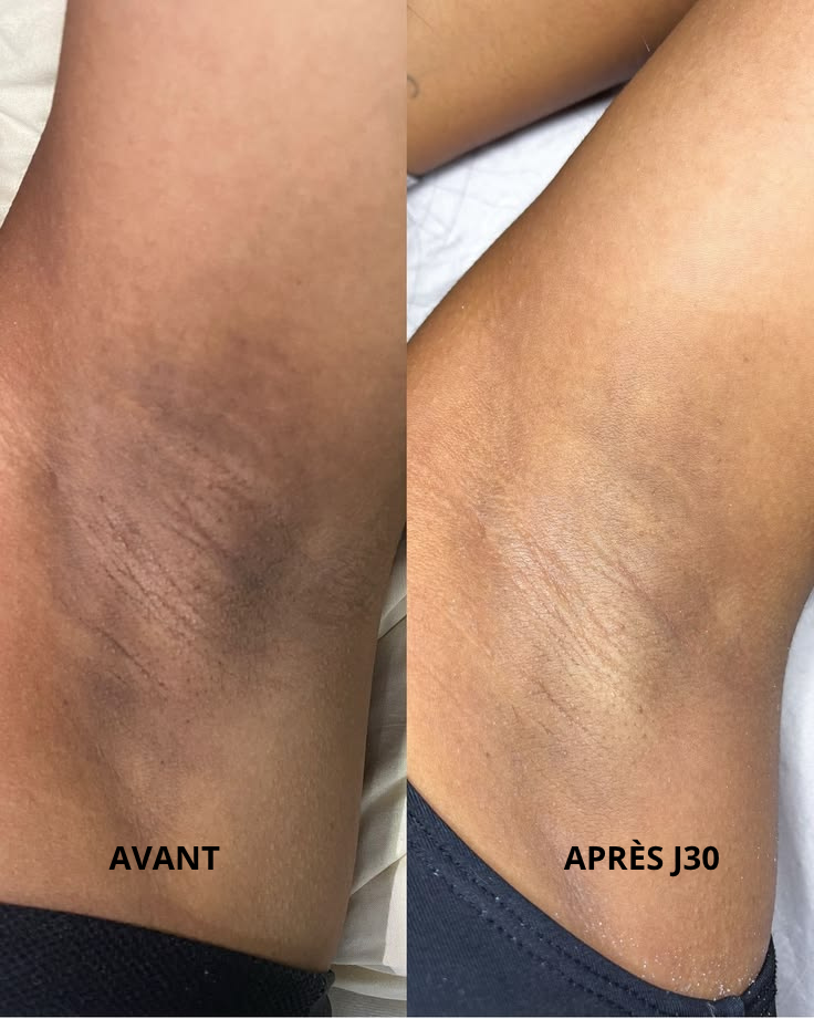 Résultat avant et après Nyali