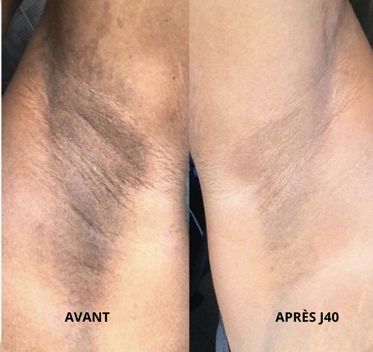 Résultat avant et après Nyali