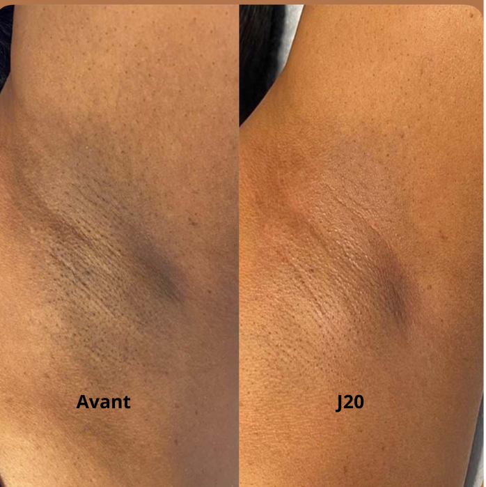 Résultat avant et après Nyali