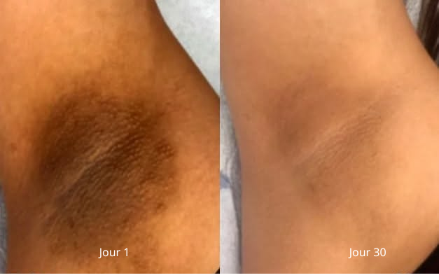 Résultat avant et après Nyali