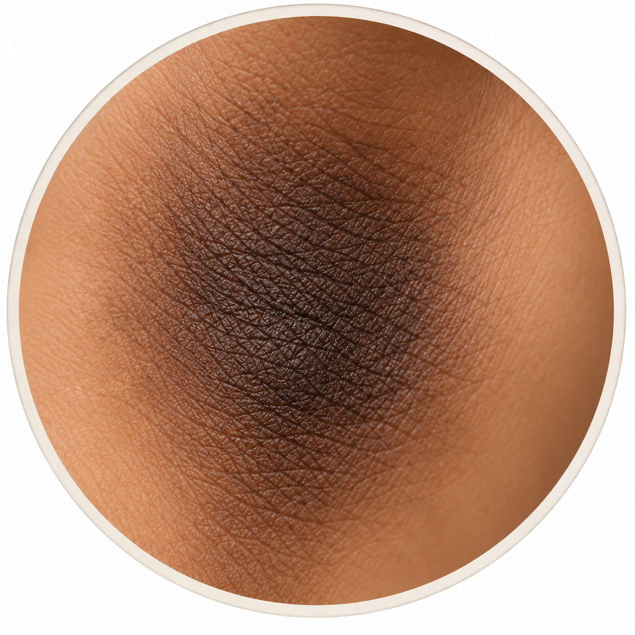 Hyperpigmentation des aisselles